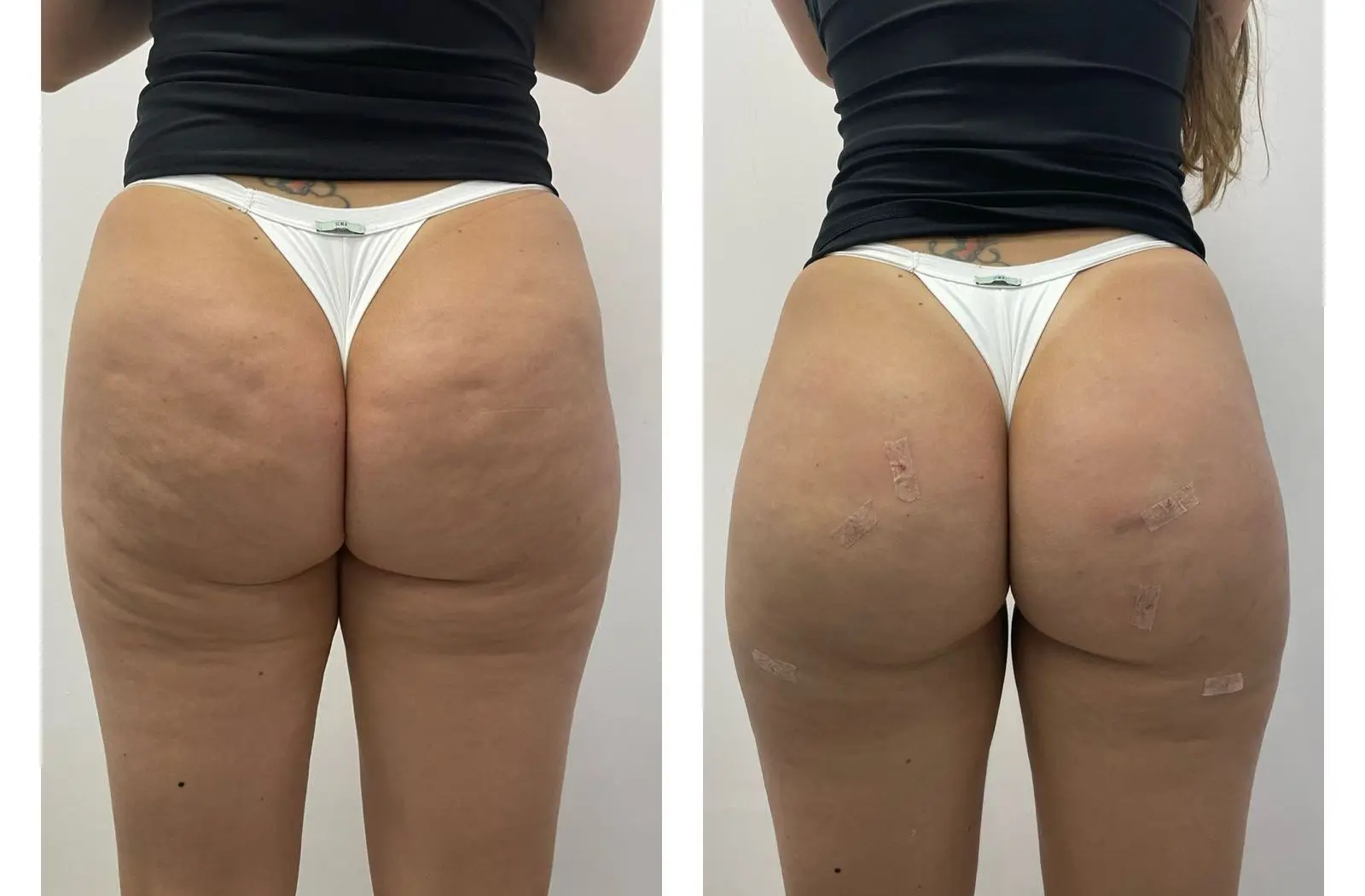 gluteo-4.webp