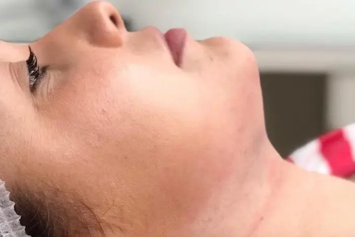 lipo-de-papada-4.webp