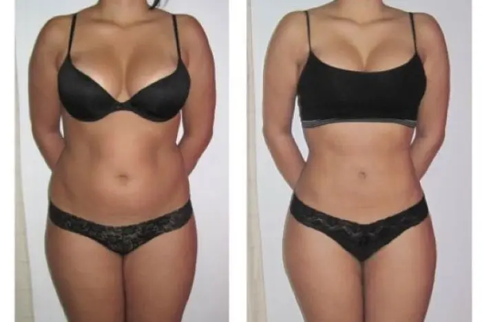 lipo-sem-corte-3.webp