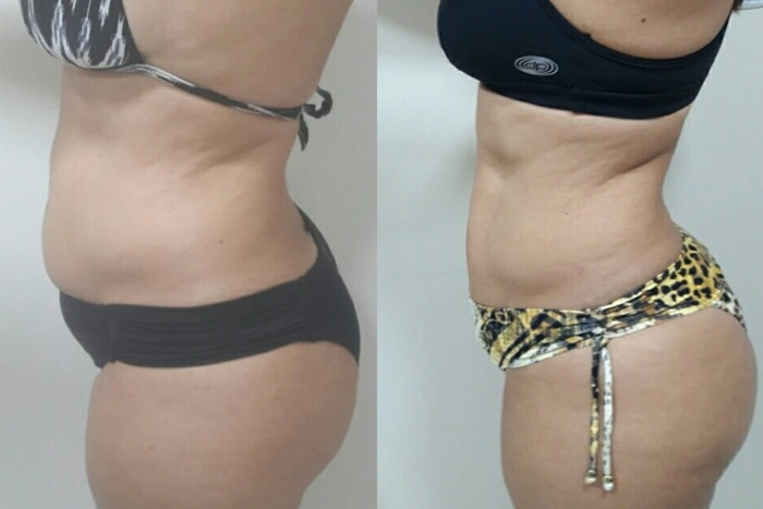 lipo-sem-corte-4.webp