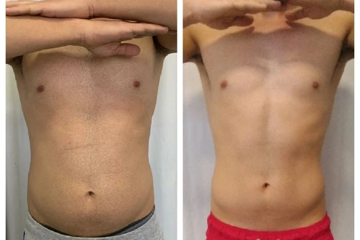 lipo-sem-corte-5