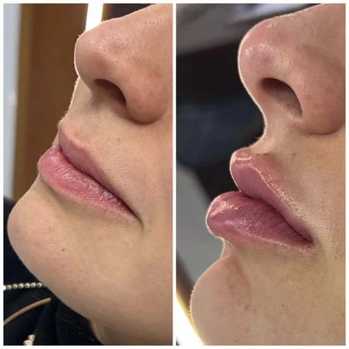 preenchimento-labial-2.webp
