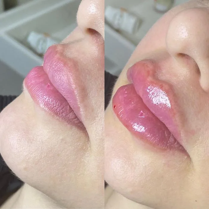preenchimento-labial-3.webp