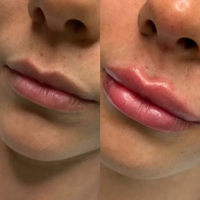 preenchimento-labial-6.webp