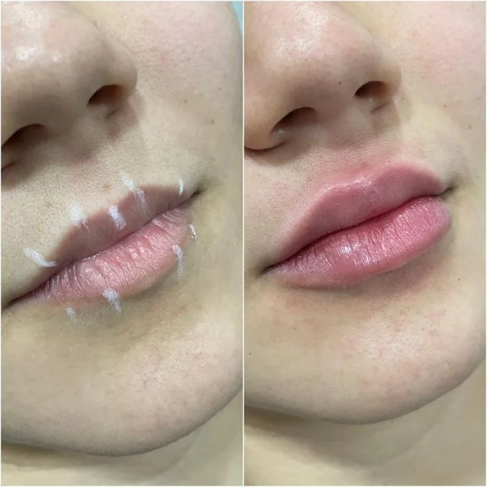preenchimento-labial.webp
